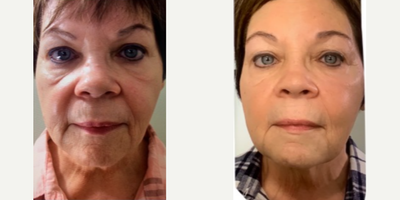 Thread Lift before and after photo