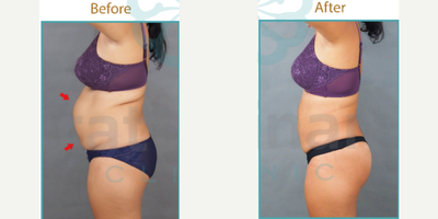 BodyTite before and after photo