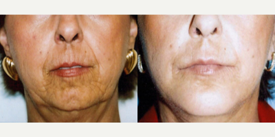 Chin Implant before and after photo