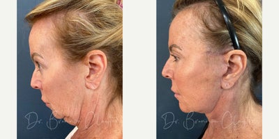 Deep Plane Facelift before and after photo