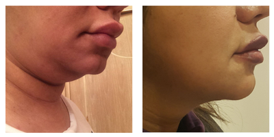 Genioplasty before and after photo