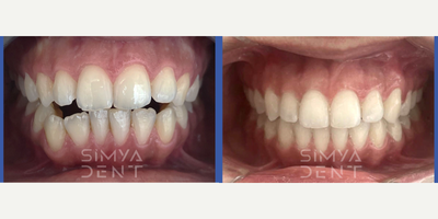 Invisalign before and after photo