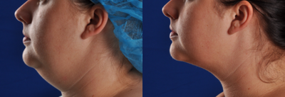 Laser Liposuction before and after photo