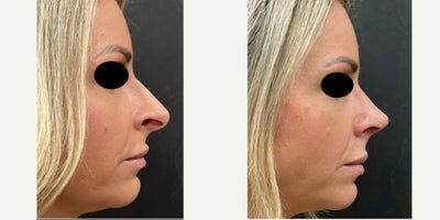 Rhinoplasty before and after photo