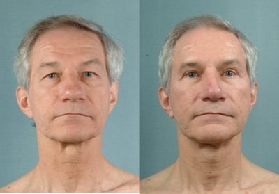 Eyelid Surgery before and after photo