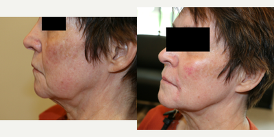 Radiesse before and after photo