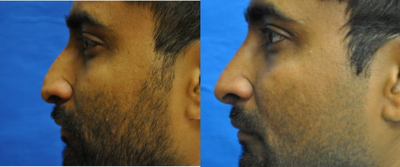 Rhinoplasty before and after photo
