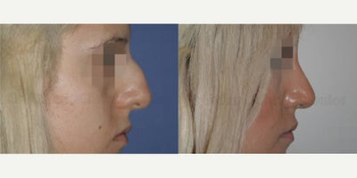 Rhinoplasty before and after photo