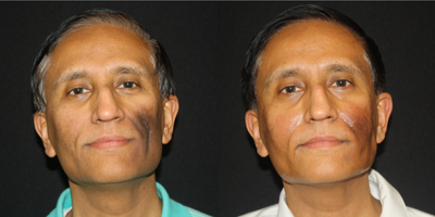 Sculptra before and after photo