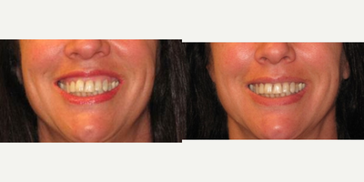 Botox for Gummy Smile before and after photo