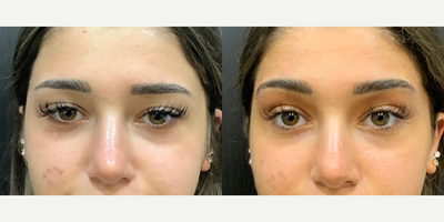Botox before and after photo