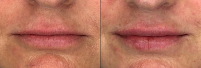 Dermal Fillers before and after photo