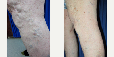 EVLT before and after photo
