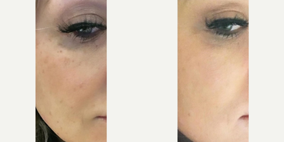 IPL before and after photo