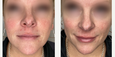 Lip Fillers before and after photo