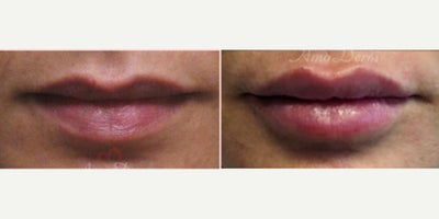 Lip Fillers before and after photo