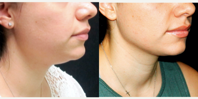 Chin Liposuction before and after photo