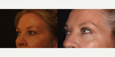 Eyebrow Transplant before and after photo