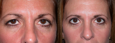 Eyelid Surgery before and after photo