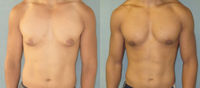 Gynecomastia Surgery before and after photo