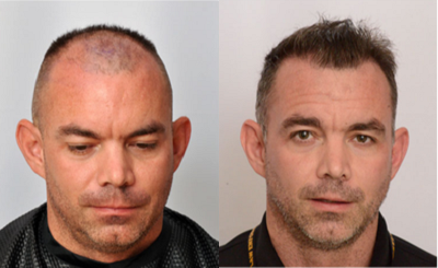 Hair Transplant before and after photo