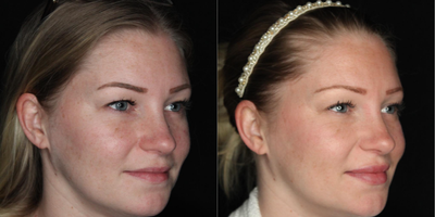 Juvederm before and after photo