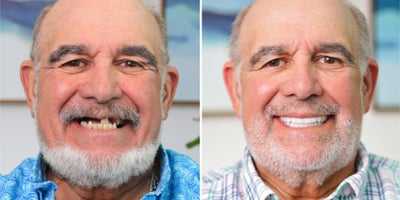 All-on-4 Dental Implants before and after photo