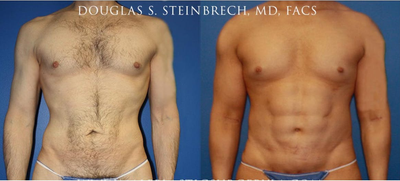 Bicep Implants before and after photo
