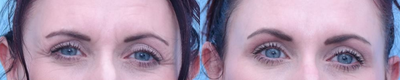 Botox before and after photo