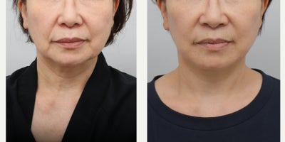 Eyelid Surgery before and after photo