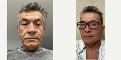 Eyelid Surgery before and after photo