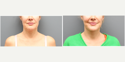Facelift before and after photo