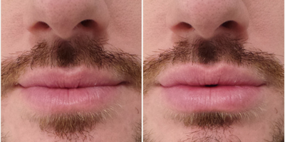 Juvederm before and after photo