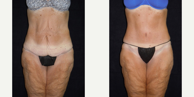 Tummy Tuck before and after photo