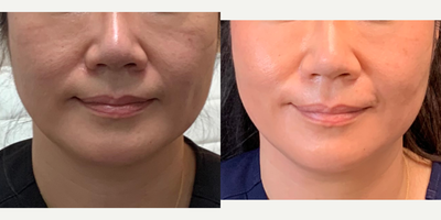 Chin Filler before and after photo