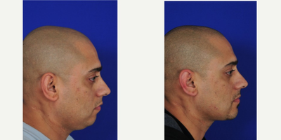 Chin Implant before and after photo