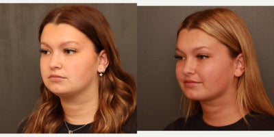 Neck Lift before and after photo