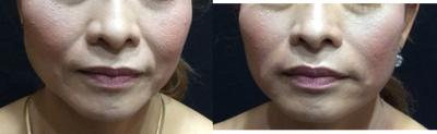 Radiesse before and after photo