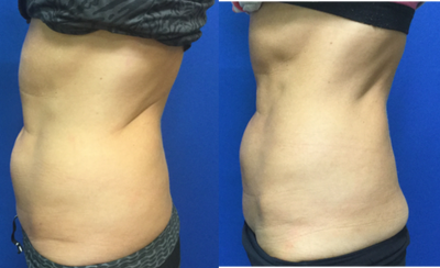 CoolSculpting before and after photo