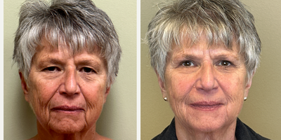 Eyelid Surgery before and after photo