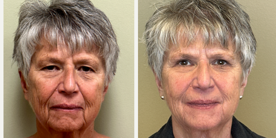 Eyelid Surgery before and after photo