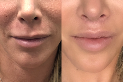 Lip Lift before and after photo