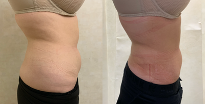 Liposuction before and after photo
