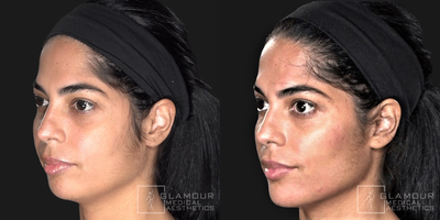 Voluma before and after photo