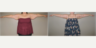 BodyTite before and after photo