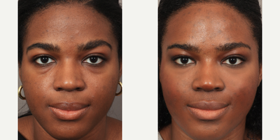 Brow Lift before and after photo