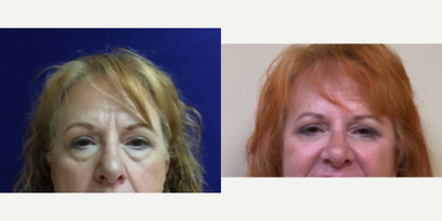 Eyelid Surgery before and after photo