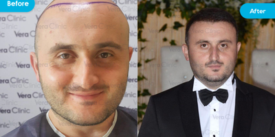 Hair Transplant before and after photo