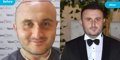 Hair Transplant before and after photo