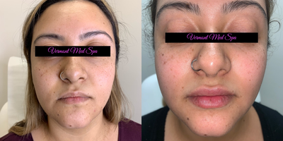 Lip Fillers before and after photo